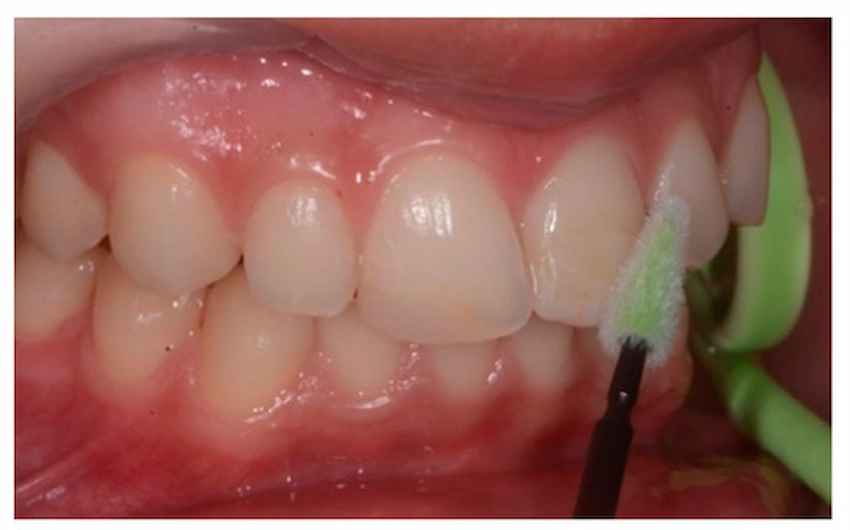 cancro della guancia interna