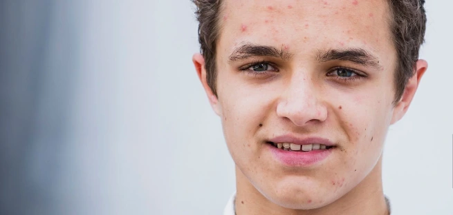 lando-norris-teeth-in-2017