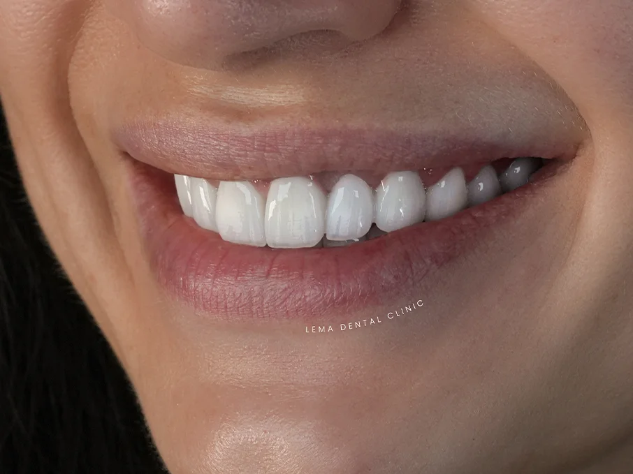 root canal treatment.webp