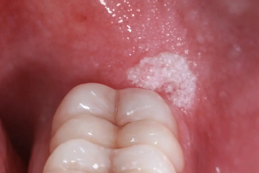 queratosis-benigna-de-la-cresta-alveolar