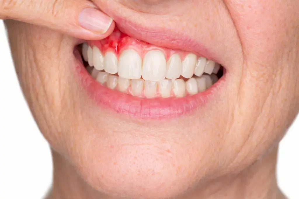 signs-of-peri-implantitis