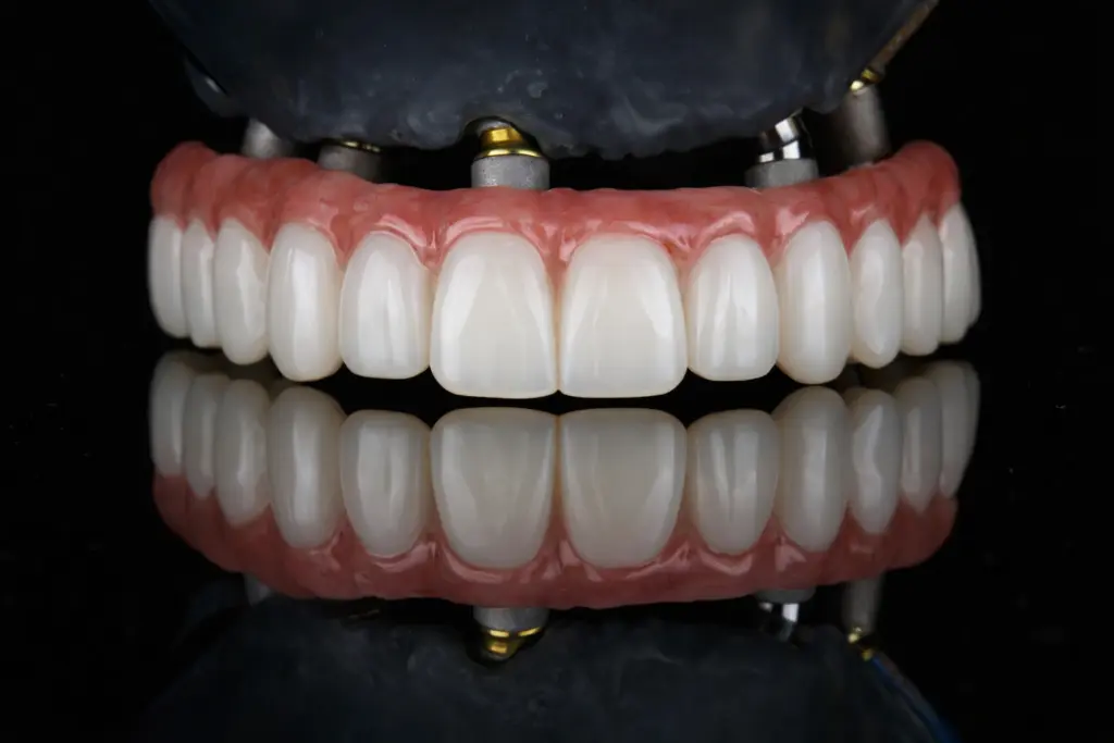 all-on-x-dental-implants-before-after