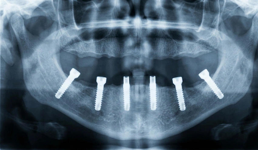 ajutised-hambad-all-on-4-taastumine