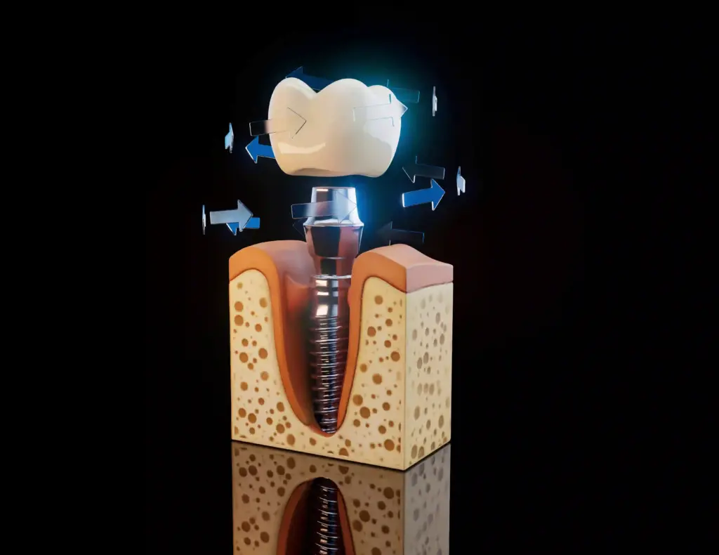 dental-implant-rest-period