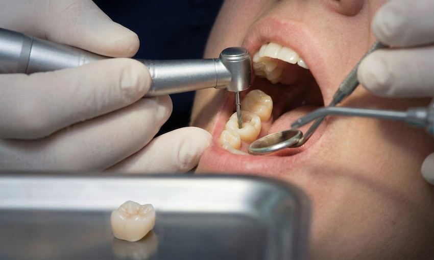 Porcelain Inlays and Onlays: What Are the Benefits? | LEMA