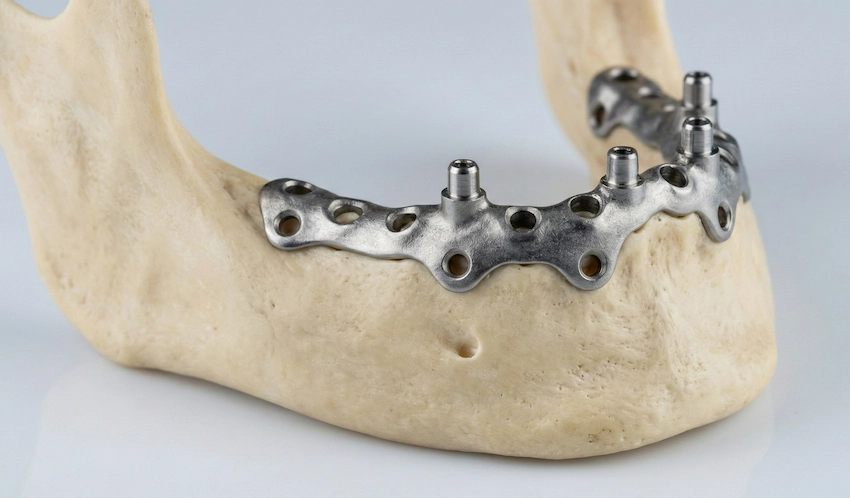 процедура подпериостальных имплантов в Турции