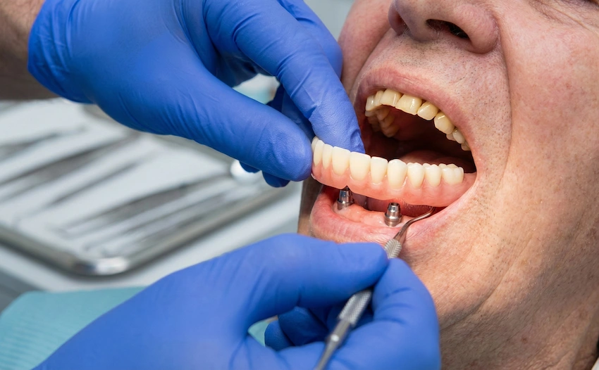 which types dentures