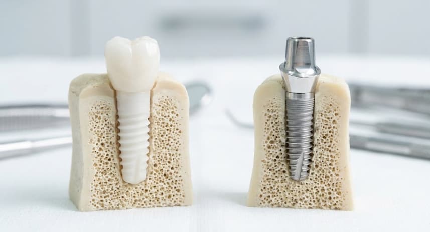 alternatives-aux-implants-dentaires-turquie