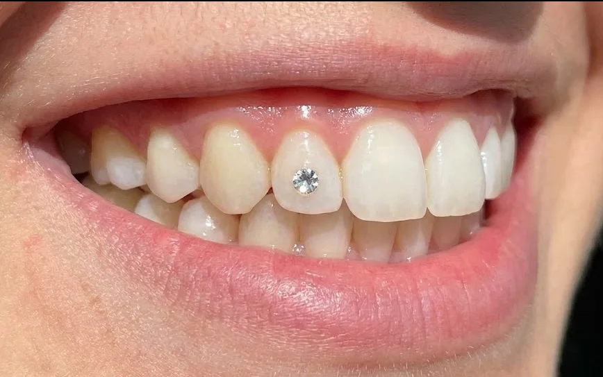 a sparkling tooth gem