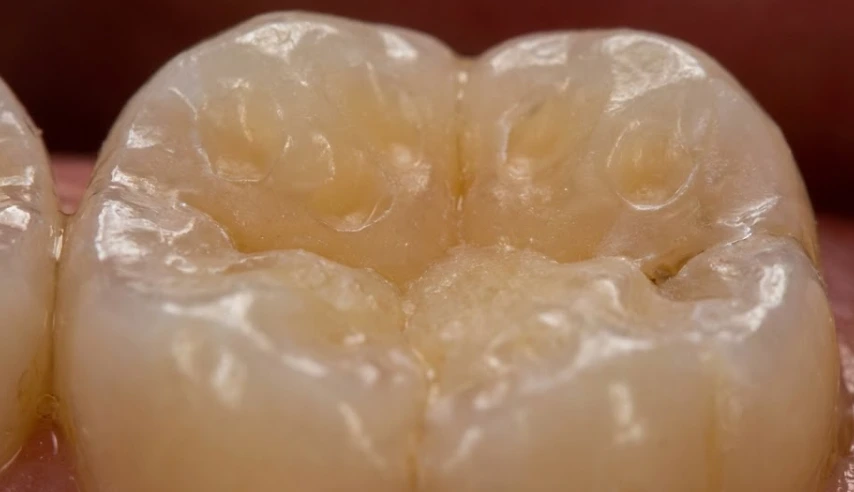 acid-erosion-on-human-tooth