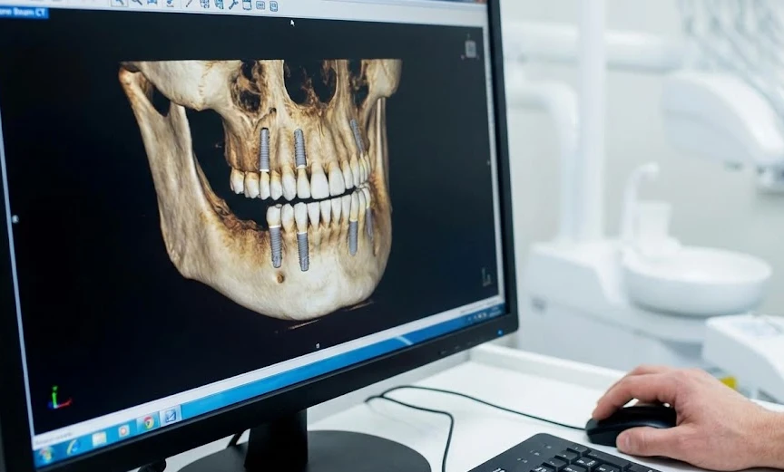 arenenud 3D digitaalne implantatsiooni planeerimine