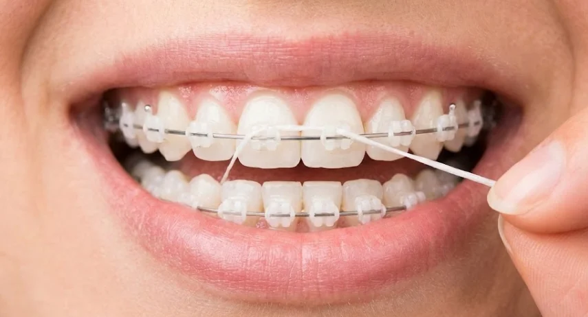 archwire-blocking-traditional-flossing