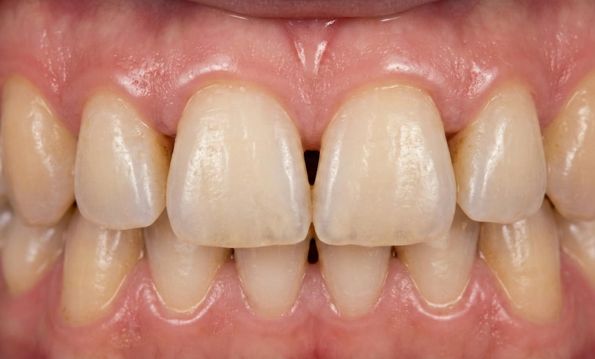 mustad triangle