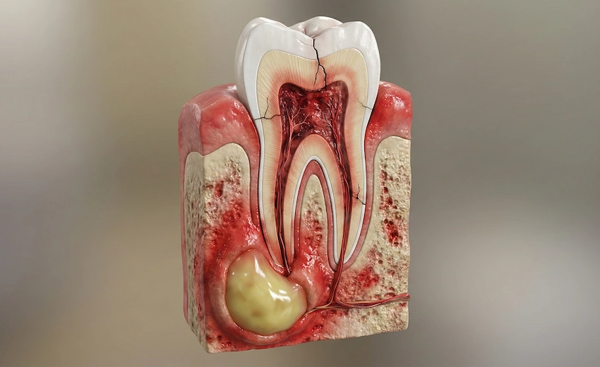 can you actually fix a dental abscess