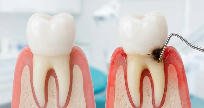 caring-for-dental-crowns-how-to-prevent-decay-under-the-crown