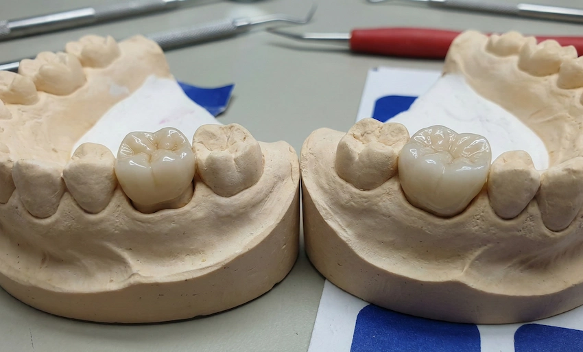 keraamilised inlays vs onlays