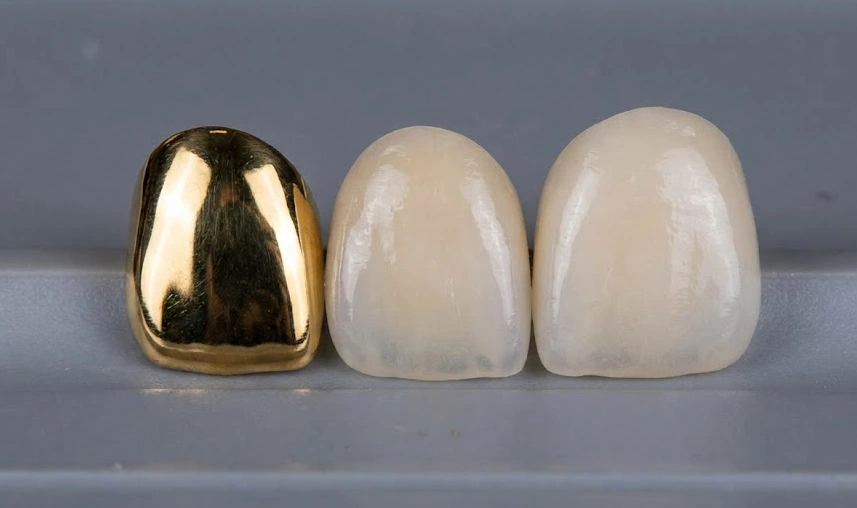 comparación de varias coronas dentales