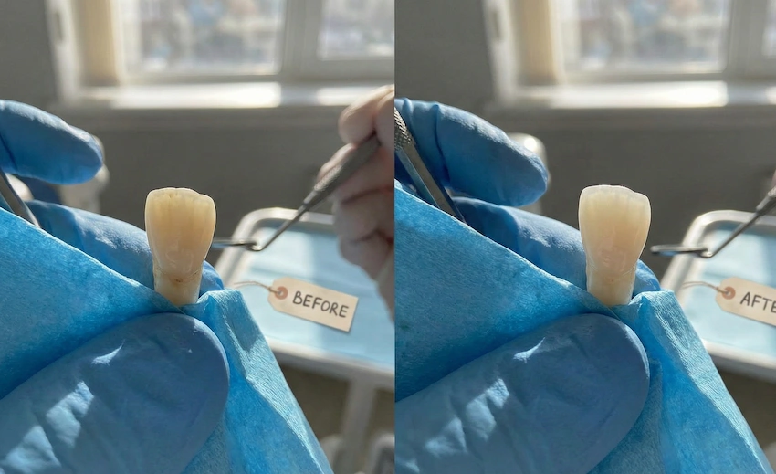dark after a root canal before after