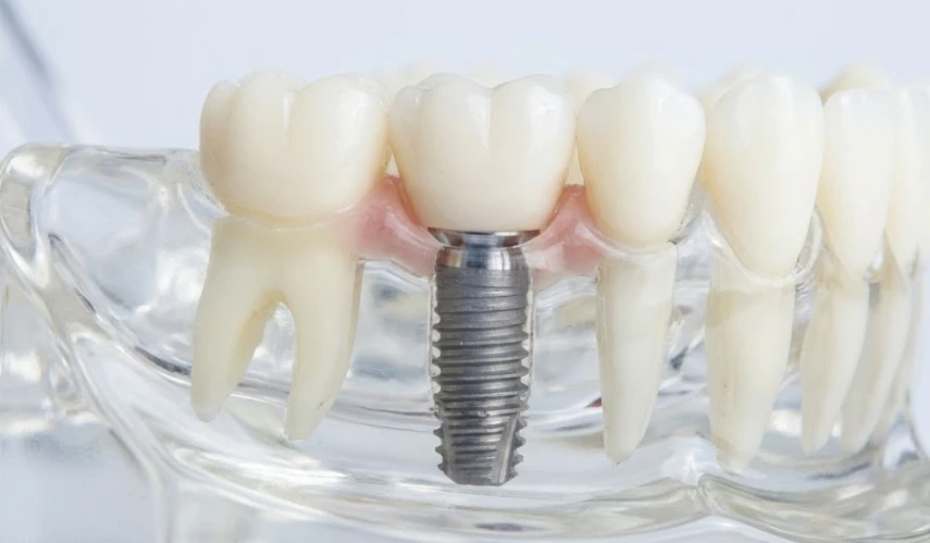 dental-implant-integrated-with-jawbone