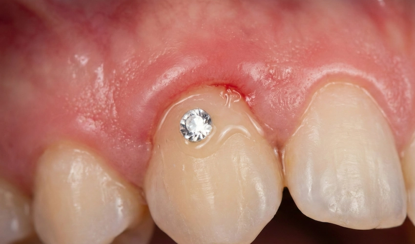 diy dental diamond kits are a danger