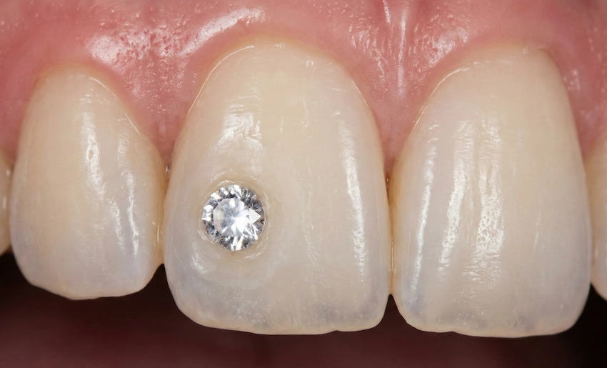 diy dental diamond kits