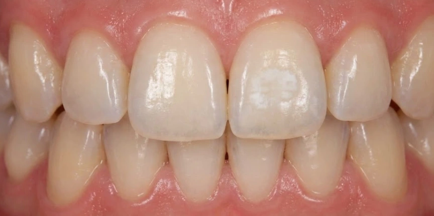 early-chalky-white-spot-lesion