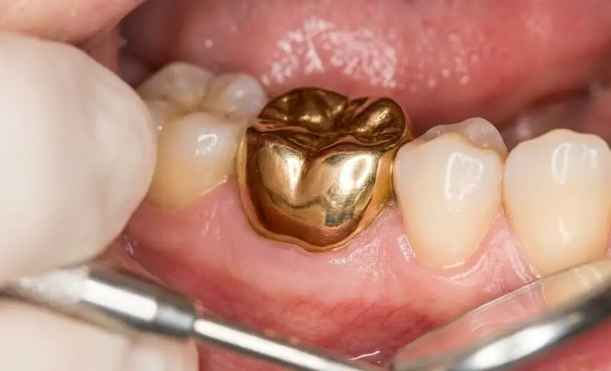 expertly-placed-permanent-gold-tooth