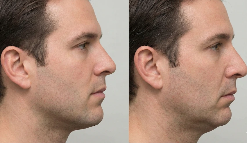 rostro y hueso de la mandíbula