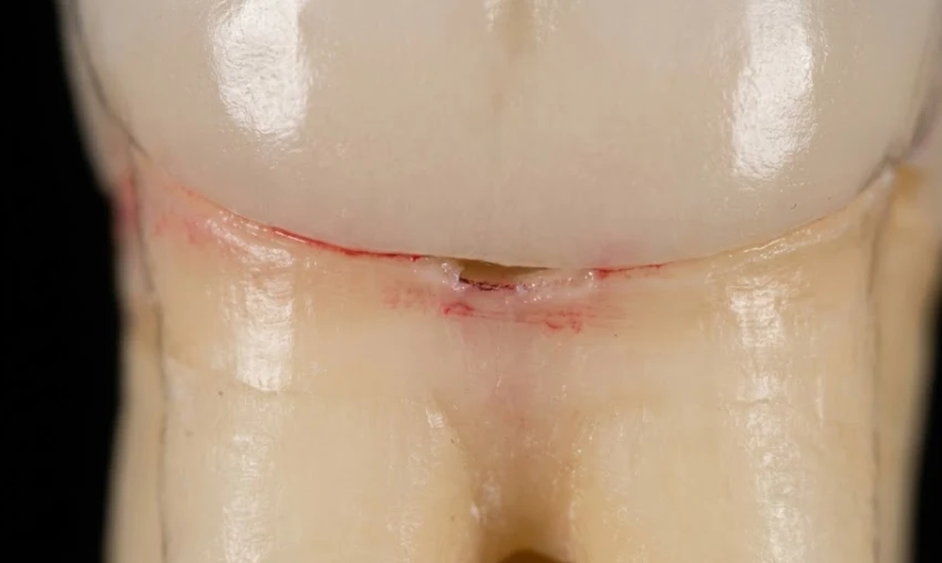 щель, через которую проникает кариес под коронкой