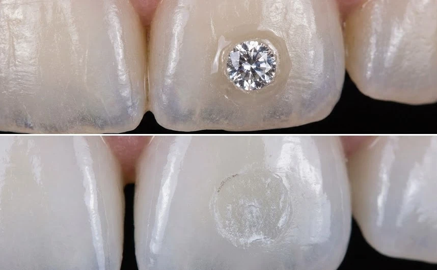 gem removal damage on porcelain