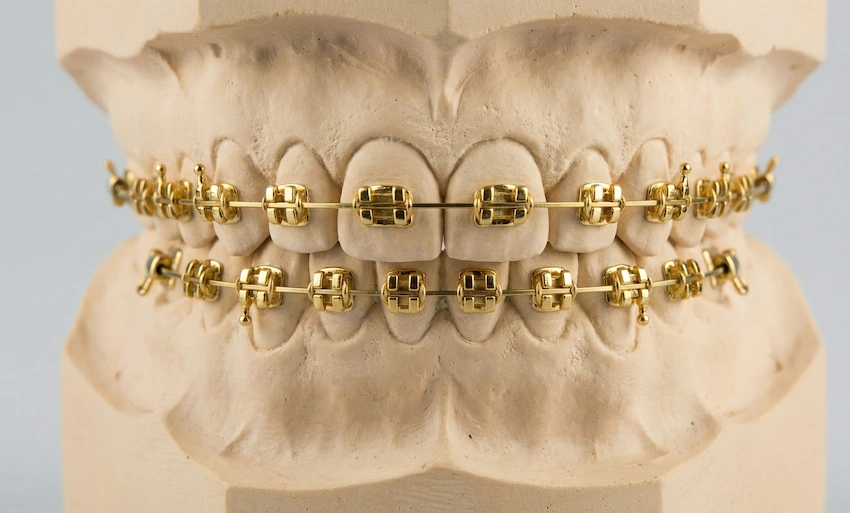 golden braces luxury orthodontics in turkey