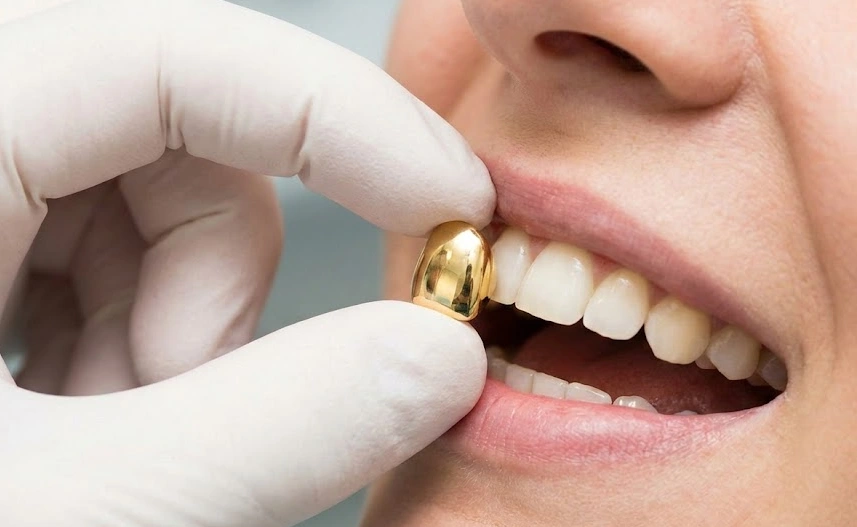 aplicación de corona de oro para diente frontal