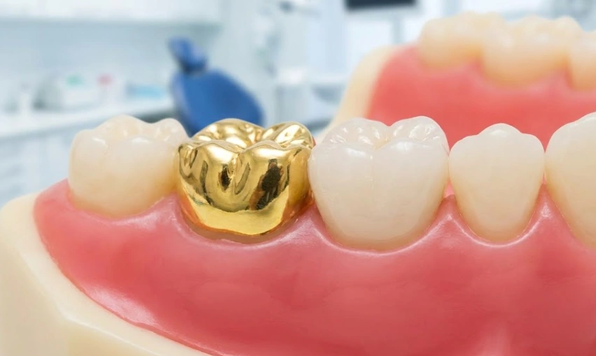 comparación de corona de oro con zirconia blanca