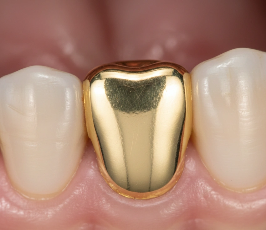 dinți de aur în Turcia