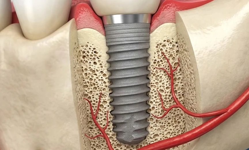 terve luumass implantatsiooni ümber