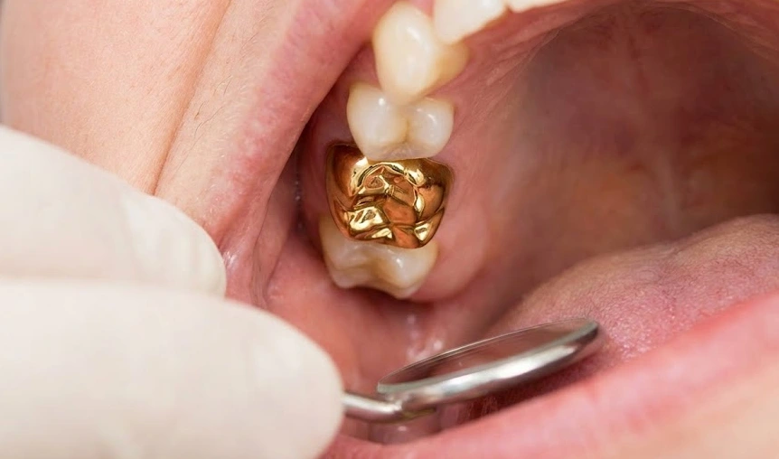 gencives saines autour d'une couronne en or