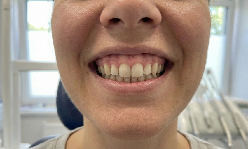 hollywood smile for a gummys smile