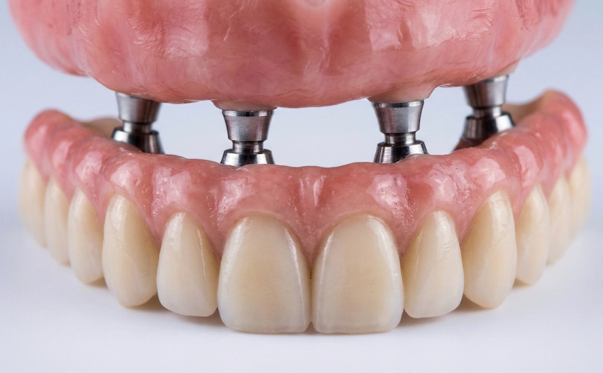 how dental implants revolutionize