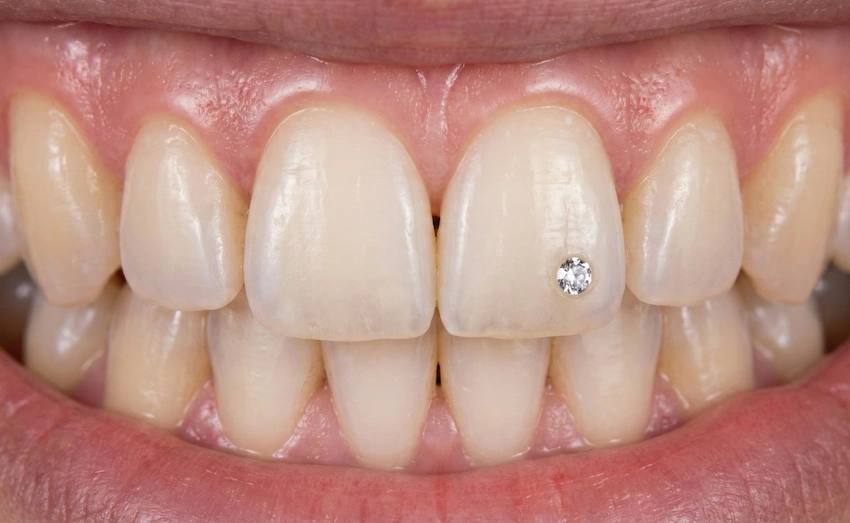 how long do tooth diamonds really last