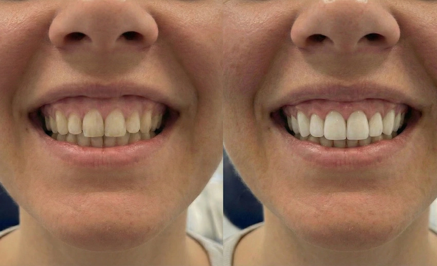 how to design a hollywood smile for a gummys smile