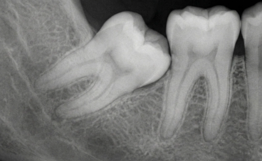 radiografía dental de muelas impactadas