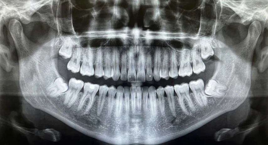 impacted-wisdom-tooth-pushing-molar