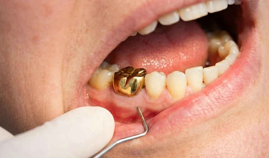 gencives enflammées près d'une couronne en or