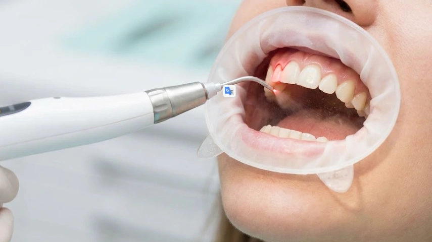 laser-gum-reshaping-procedure-in-progress