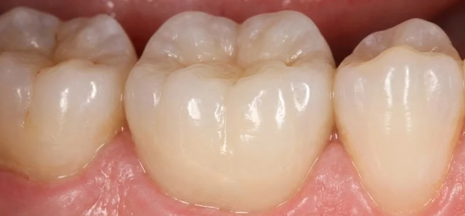modern metal free zirconia crown