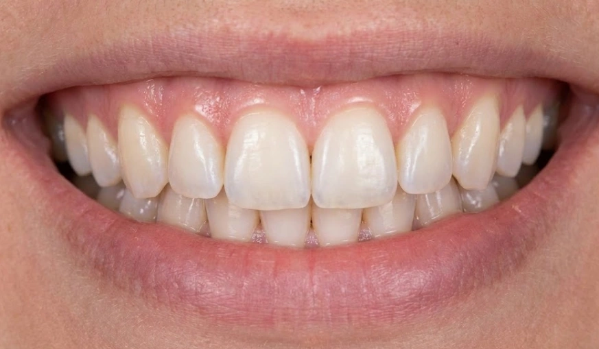 ابتسامة طبيعية المظهر مع شفافية واقعية