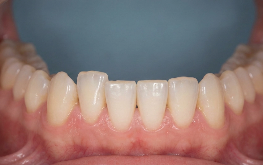 orthodontic relapse front teeth