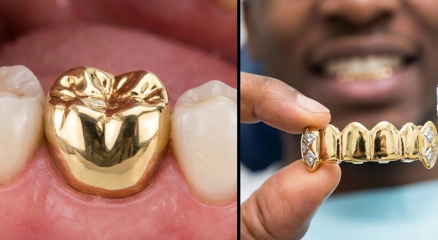 couronnes permanentes vs grills amovibles