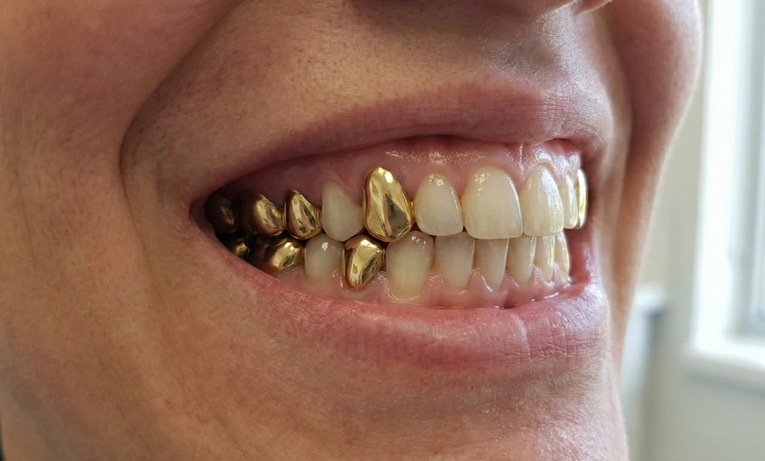 dientes de oro permanentes