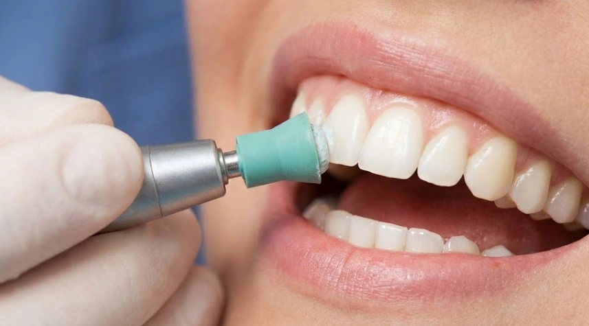 polissage des dents pour finition lisse